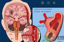 腦出血的發(fā)病因素是什么？腦出血的并發(fā)癥有哪些？