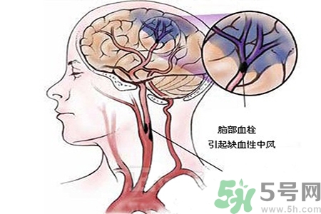 腦出血的治療方法是什么？腦出血可以用哪些藥物治療？
