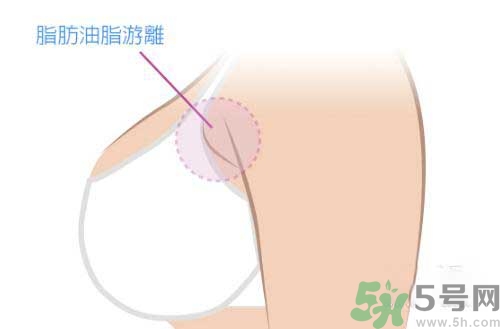 副乳是什么？副乳的危害