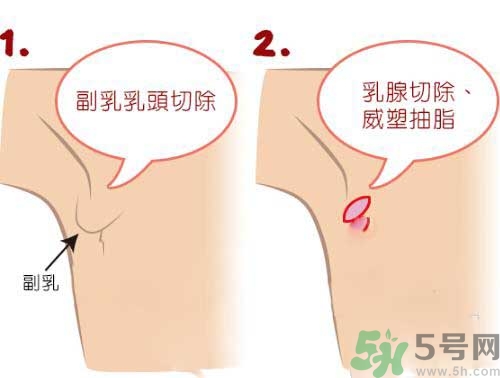 副乳是什么？副乳的危害