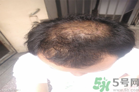 脫發(fā)的措施有什么？脫發(fā)的注意飲食有哪些？