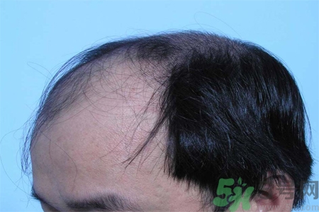 脫發(fā)的措施有什么？脫發(fā)的注意飲食有哪些？