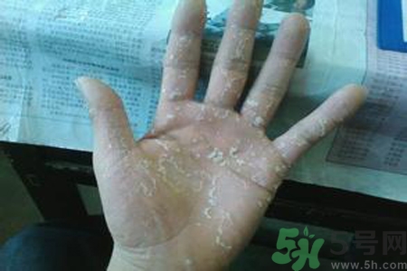 引起手足癬的主要原因？手足癬會引發(fā)什么疾病？
