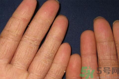 手足癬的治療方法？治療手足癬可以用什么藥？