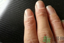 手足癬的治療方法？治療手足癬可以用什么藥？