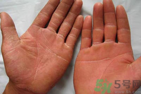 手足癬的治療方法？治療手足癬可以用什么藥？