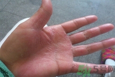 手足癬的易發(fā)人群有哪些？如何預(yù)防手足癬？