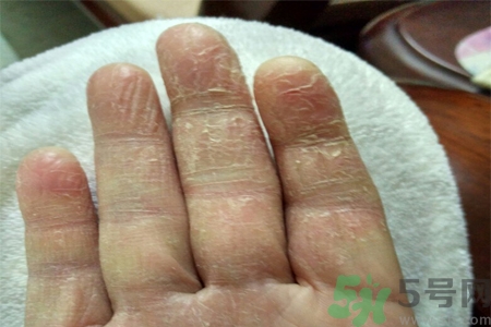 手足癬會傳染嗎？手足癬的傳播途徑有哪些？