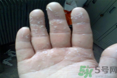 手足癬的易發(fā)人群有哪些？如何預(yù)防手足癬？