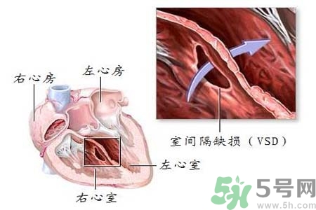 心臟病是怎么形成的？易發(fā)人群有哪些？