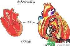心臟病的癥狀是什么？心臟病的種類有哪些？