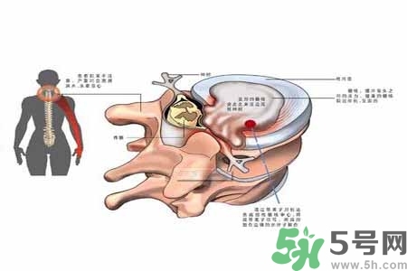 為什么年輕人容易得頸椎?。款i椎病嚴(yán)重的癥狀有哪些？