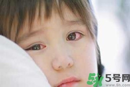 寶寶為什么會(huì)感染紅眼病？寶寶患紅眼病如何治療？