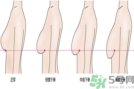 ?女性乳房下垂的原因是什么？女性乳房下垂的分類有哪些？