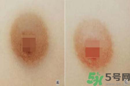 乳頭發(fā)黑怎么辦？怎么樣可以使乳頭變白？