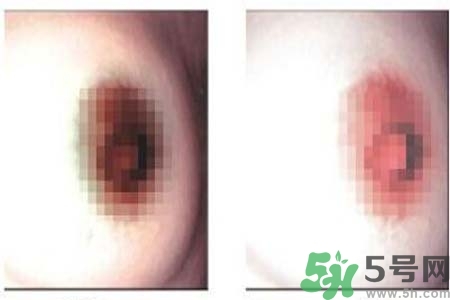 乳頭發(fā)黑怎么辦？怎么樣可以使乳頭變白？