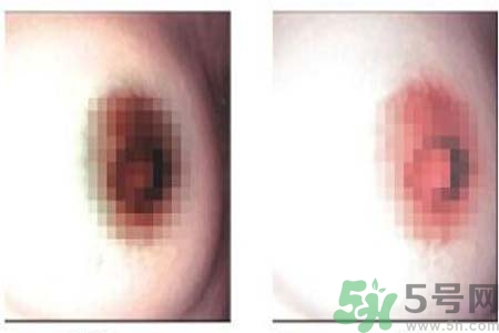 乳頭發(fā)黑是怎么回事？乳頭發(fā)黑是什么原因？