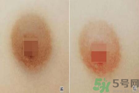 乳頭發(fā)黑是怎么回事？乳頭發(fā)黑是什么原因？