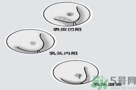 乳頭內(nèi)陷怎么回事？乳頭內(nèi)陷的原因是什么？