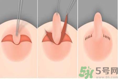 乳頭內(nèi)陷怎么回事？乳頭內(nèi)陷的原因是什么？