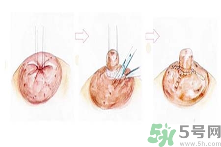 乳頭內(nèi)陷怎么回事？乳頭內(nèi)陷的原因是什么？