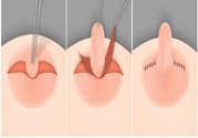 乳頭內(nèi)陷怎么辦？乳頭內(nèi)陷的癥狀有哪些？