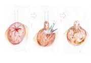 乳頭內(nèi)陷矯正需注意什么？乳頭內(nèi)陷如何預(yù)防？