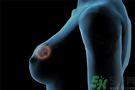 乳房屋硬塊有疼痛感怎么回事？乳房屋硬塊有疼痛感怎么辦？
