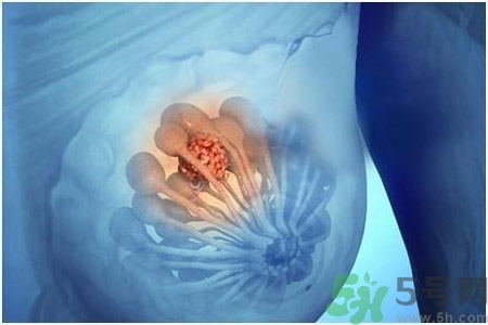 乳房屋硬塊有疼痛感怎么回事？乳房屋硬塊有疼痛感怎么辦？