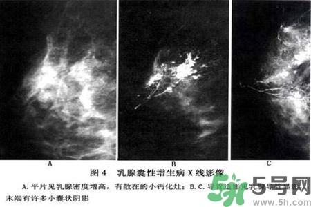 產(chǎn)生乳腺增生鈣化的病因是什么？乳腺增生怎樣治療？
