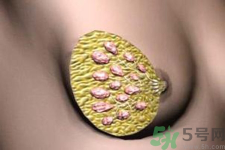 產(chǎn)生乳腺增生鈣化的病因是什么？乳腺增生怎樣治療？