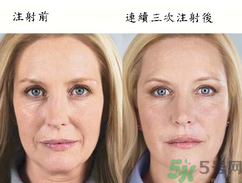 3D液態(tài)拉皮多少錢？3D液態(tài)拉皮后多久見效？