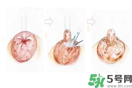 乳頭內(nèi)陷怎么矯正？乳頭內(nèi)陷矯正方法是什么？