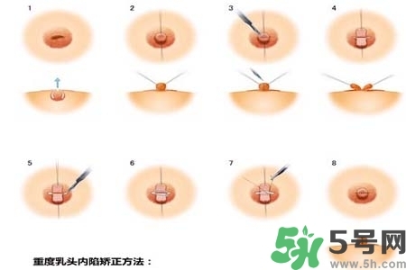 乳頭內(nèi)陷怎么矯正？乳頭內(nèi)陷矯正方法是什么？