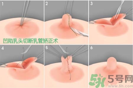 乳頭內(nèi)陷怎么矯正？乳頭內(nèi)陷矯正方法是什么？