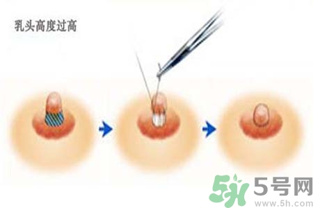 乳頭內(nèi)陷能不能喂奶？乳頭凹陷怎樣哺乳？