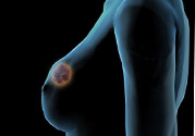哺乳期乳房有硬塊疼痛怎么辦？如何預防哺乳期乳房有硬塊？