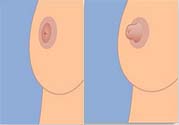 乳頭內(nèi)陷可以用吸奶器嗎？乳頭內(nèi)陷能不能用吸奶器？