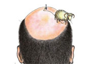 禿頂會遺傳嗎？治療禿頂?shù)姆椒ㄊ鞘裁矗?><p><strong>禿頂會遺傳嗎？治療禿頂?shù)姆椒ㄊ鞘裁矗?/strong></p></a></li> 	     </ul>
		</div>
	   <div   id=