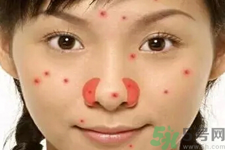 鼻翼長痘痘怎么回事？鼻翼長痘痘的原因是什么？