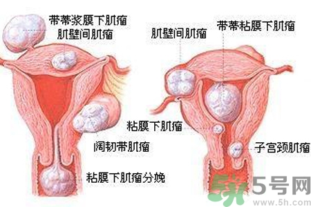 ?子宮移位怎么治療？子宮移位能懷孕嗎？