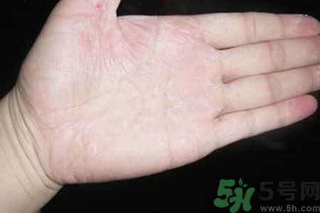 ?手掌脫皮的危害有哪些？如何預(yù)防手掌脫皮？