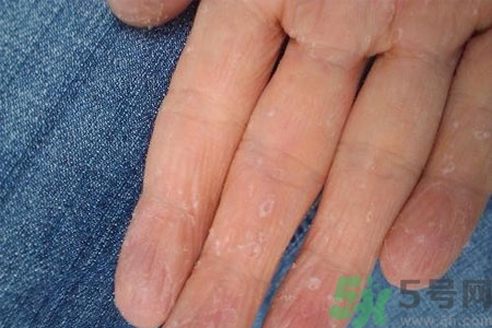 ?手掌脫皮的危害有哪些？如何預(yù)防手掌脫皮？