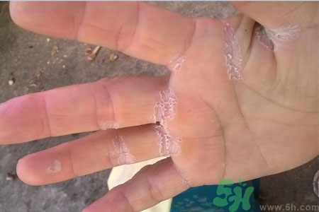 ?手掌脫皮的危害有哪些？如何預(yù)防手掌脫皮？