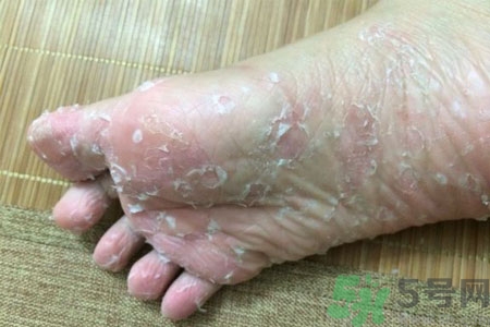腳脫皮是怎么回事？腳脫皮怎么辦？