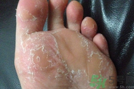 腳脫皮是怎么回事？腳脫皮怎么辦？