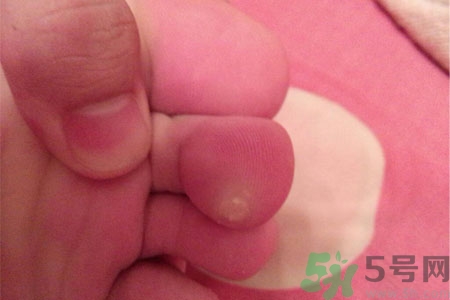 雞眼如何去除？腳上長了雞眼怎么治療？