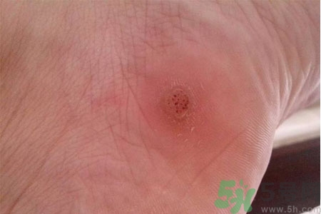 腳上長雞眼是怎么回事？腳上長雞眼是怎么辦？