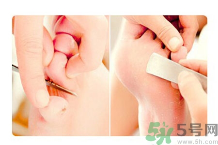 雞眼怎么能徹底根治？如何預(yù)防腳上長(zhǎng)雞眼？