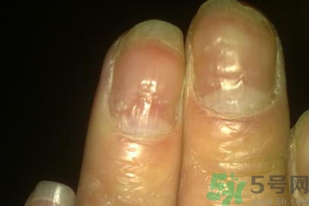 孩子手指甲凹凸不平是什么原因？手指甲凹凸不平的原因是什么？